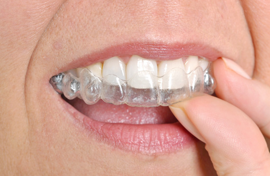 How long before I start to see results with Invisalign?