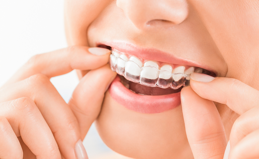 Invisalign Orthodontic Treatment for Comfort and Convenience